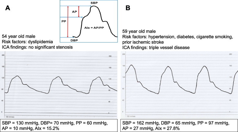 Arterial stiffness and hypertension.