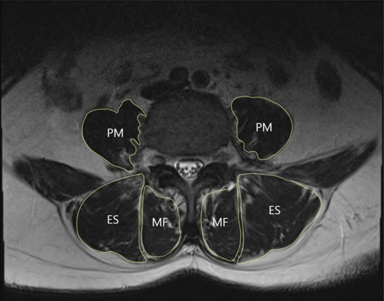 The Relationship Between Low Back Pain and Sagittal Spinal Alignment and Back Muscle Mass in Korean Fishery Workers.