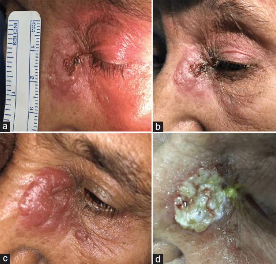 Self-administration of herbal treatment for periocular cutaneous leishmaniasis: A case report and systematic review.