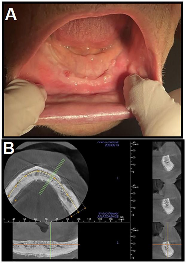 Role of Actinomyces spp. and related organisms in the development of medication-related osteonecrosis of the jaw (MRONJ): Clinical evidence based on a case series.