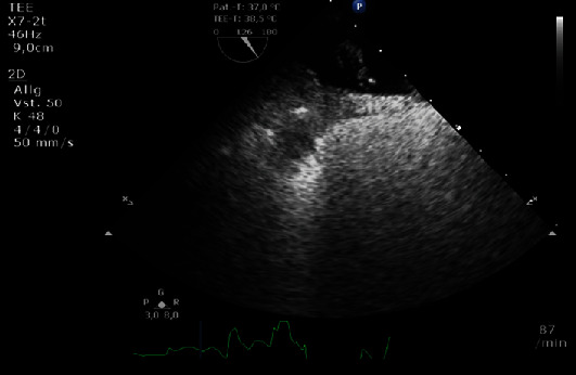 Pacemaker Lead Entanglement during Interventional PFO Occlusion: Salvage Using a Sizing Balloon.