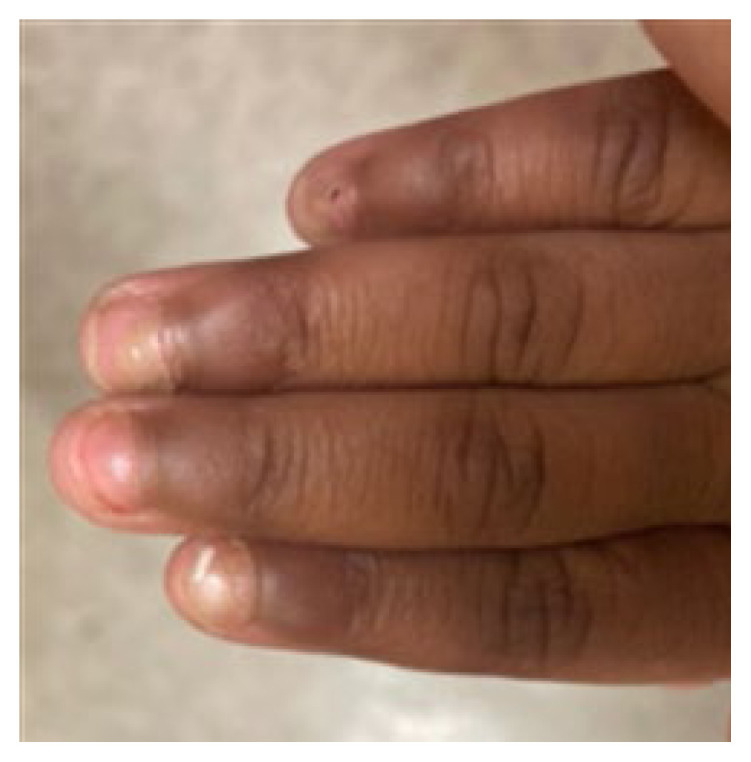 Common Post-Viral Sequalae: Onychomadesis in Setting of Giannoti Crosti Syndrome.