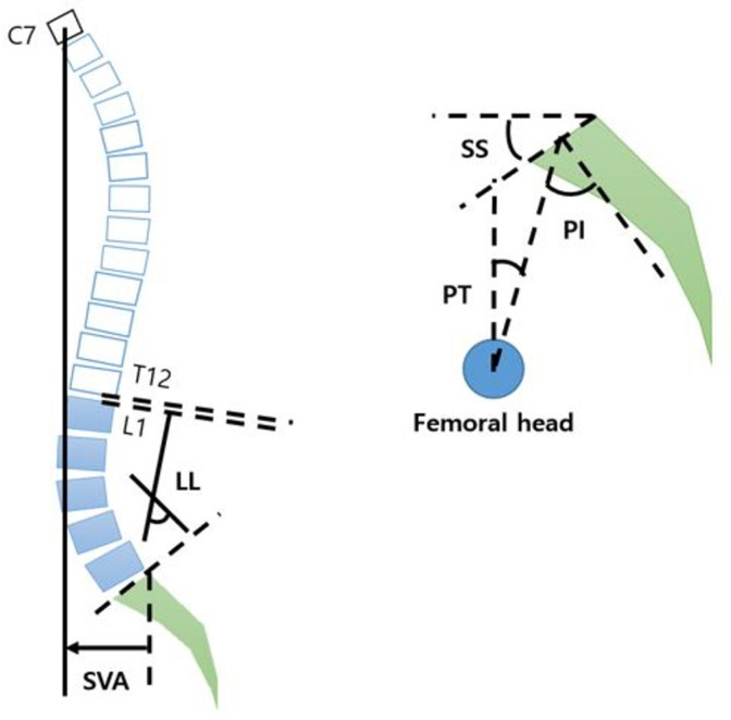 The Relationship Between Low Back Pain and Sagittal Spinal Alignment and Back Muscle Mass in Korean Fishery Workers.
