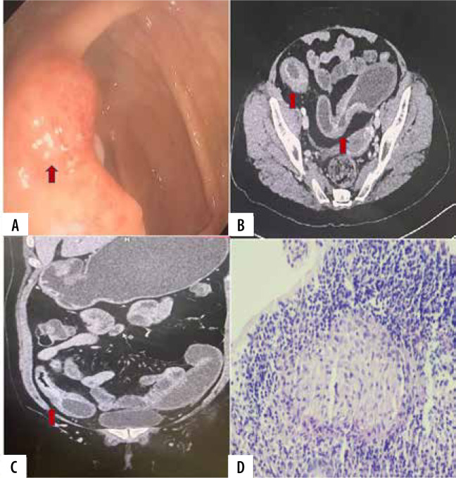 Diagnostic utility of CT enterography in the evaluation of ileocecal mucosal lesions of uncertain diagnosis on ileocolonoscopy.