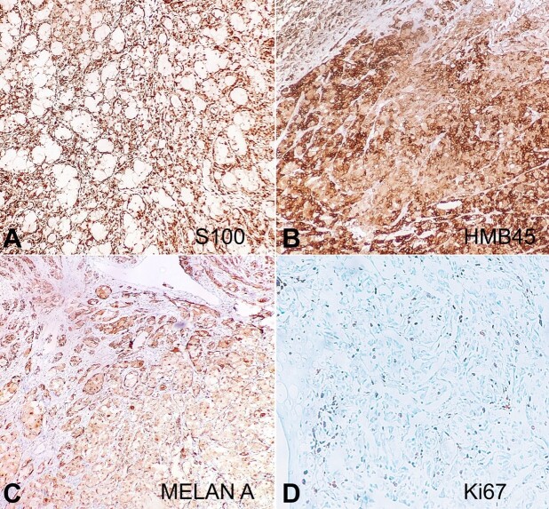 Anorectal balloon cell melanoma: a rare variant.