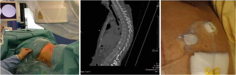 Intrathecal Catheter for Chemotherapy in Leptomeningeal Carcinomatosis From HER2-Negative Metastatic Breast Cancer.