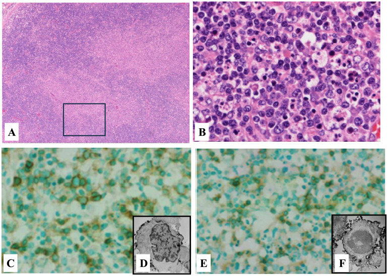 C/EBP homogenous protein-induced Apoptosis in Endoplasmic Reticulum stress has been implicated in Kikuchi-Fujimoto Disease.
