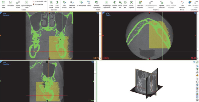 Factors affecting the reduction rate of odontogenic cysts after decompression based on 3-dimensional volumetric analysis.