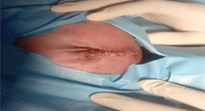 OBSTRUCTED CONGENITAL HERNIA OF UMBILICAL CORD IN A NIGERIAN NEWBORN AND ITS DIAGNOSTIC CONUNDRUM.