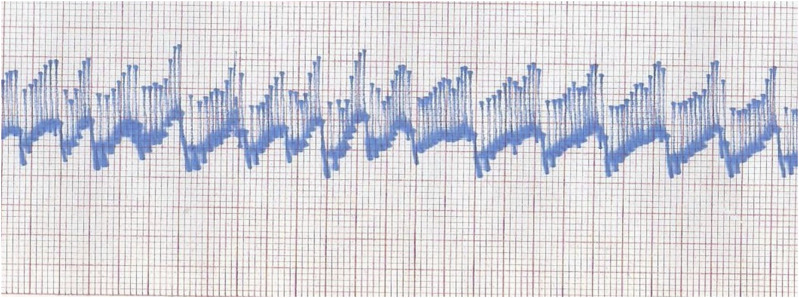 Hydraulic Joint Function and Osteoarthritis.