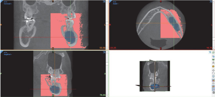 Factors affecting the reduction rate of odontogenic cysts after decompression based on 3-dimensional volumetric analysis.