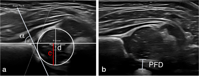 Birthweight correlates to pubo-femoral distances and α angles in hip ultrasound of newborns at 6 weeks of age: a retrospective cohort study.