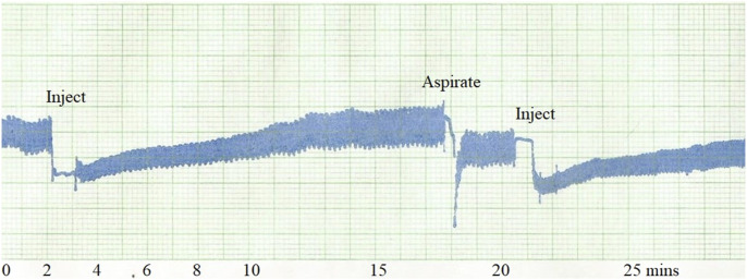 Hydraulic Joint Function and Osteoarthritis.
