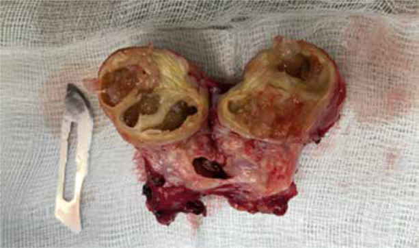 A very rare case of echinococcus granulosus arising in the ovary and the uterus.