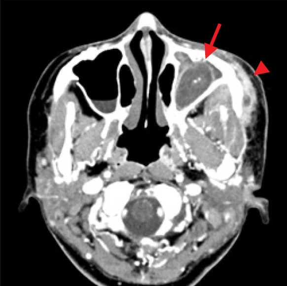 Periantral fungal abscess after zygoma reduction: a case report.