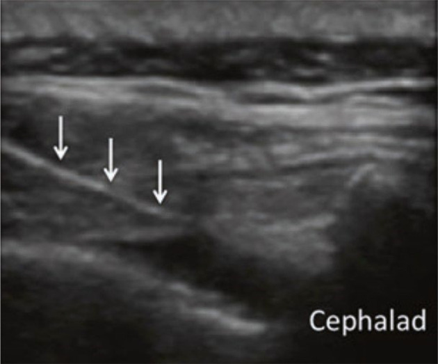 Comparative Evaluation of Caudal Epidural Method to Ultrasound-Guided S1 Transforamen Block in Patient's Lumbar Discectomy with Failed Back Syndrome Symptoms: A Double-Blind Clinical Trial.