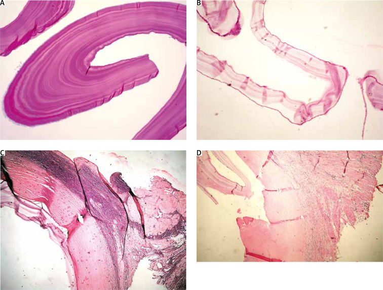 A very rare case of echinococcus granulosus arising in the ovary and the uterus.