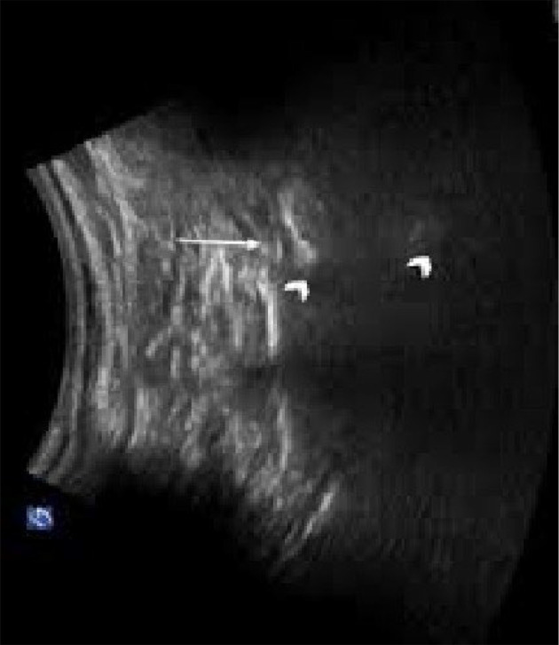Comparative Evaluation of Caudal Epidural Method to Ultrasound-Guided S1 Transforamen Block in Patient's Lumbar Discectomy with Failed Back Syndrome Symptoms: A Double-Blind Clinical Trial.