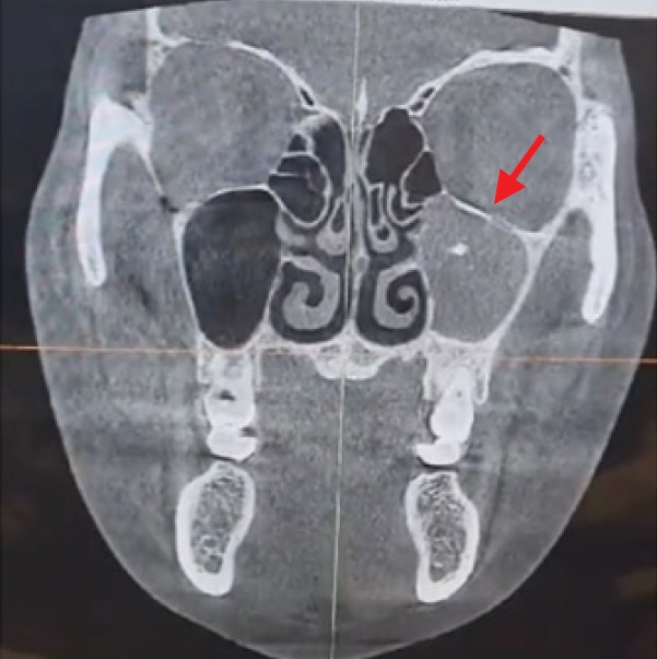 Periantral fungal abscess after zygoma reduction: a case report.