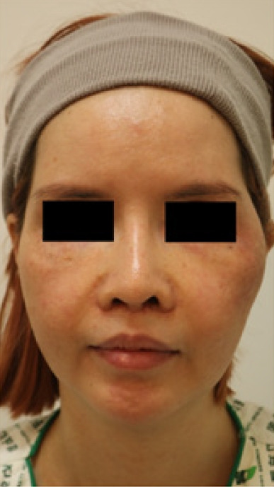 Periantral fungal abscess after zygoma reduction: a case report.