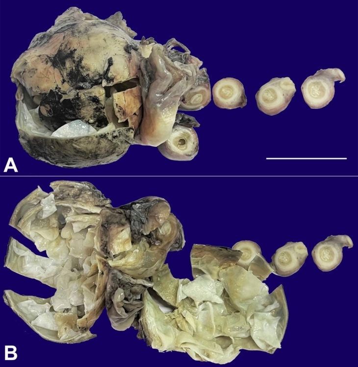 Ovarian hydatid cyst: an uncommon site of presentation.