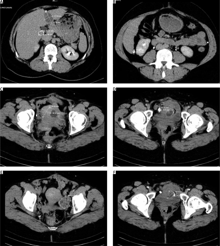 A very rare case of echinococcus granulosus arising in the ovary and the uterus.