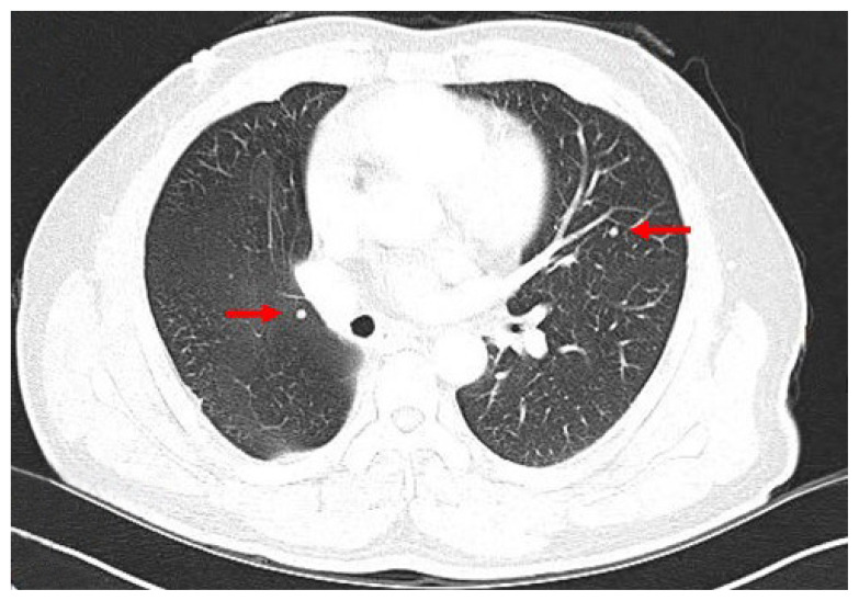 Unusual mesentery metastasis of differentiated thyroid cancer: a case report.