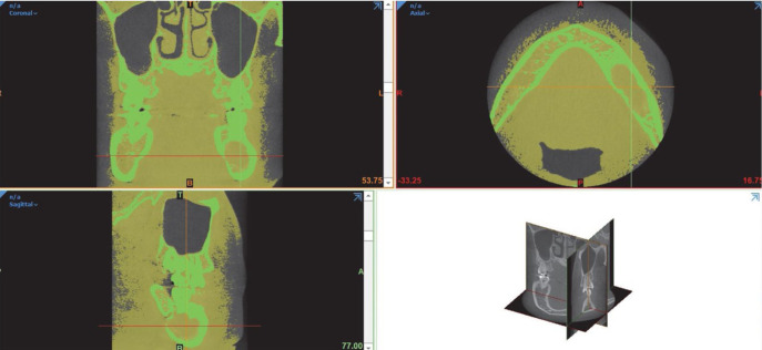 Factors affecting the reduction rate of odontogenic cysts after decompression based on 3-dimensional volumetric analysis.