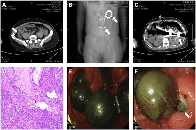 A 37-Year-Old Schizophrenic Woman With Abdominal Pain.