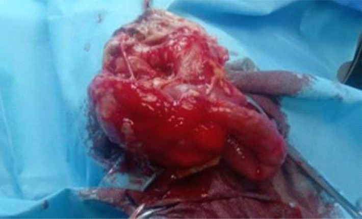 OBSTRUCTED CONGENITAL HERNIA OF UMBILICAL CORD IN A NIGERIAN NEWBORN AND ITS DIAGNOSTIC CONUNDRUM.
