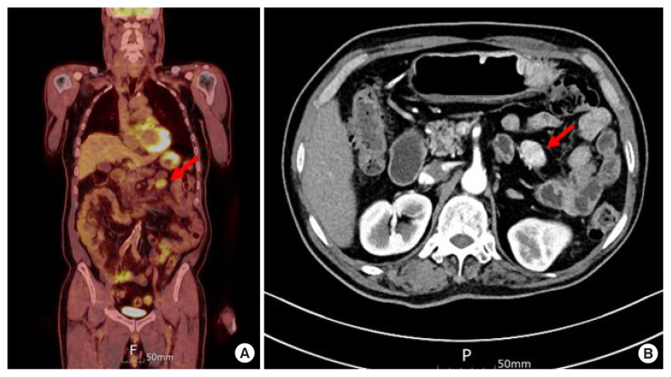 Unusual mesentery metastasis of differentiated thyroid cancer: a case report.