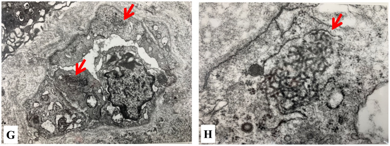 C/EBP homogenous protein-induced Apoptosis in Endoplasmic Reticulum stress has been implicated in Kikuchi-Fujimoto Disease.