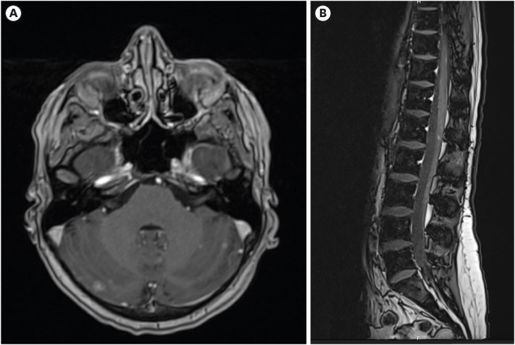 Intrathecal Catheter for Chemotherapy in Leptomeningeal Carcinomatosis From HER2-Negative Metastatic Breast Cancer.