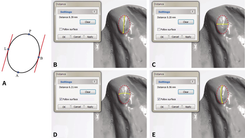 Three-dimensional morphometric study on the retromolar pad.