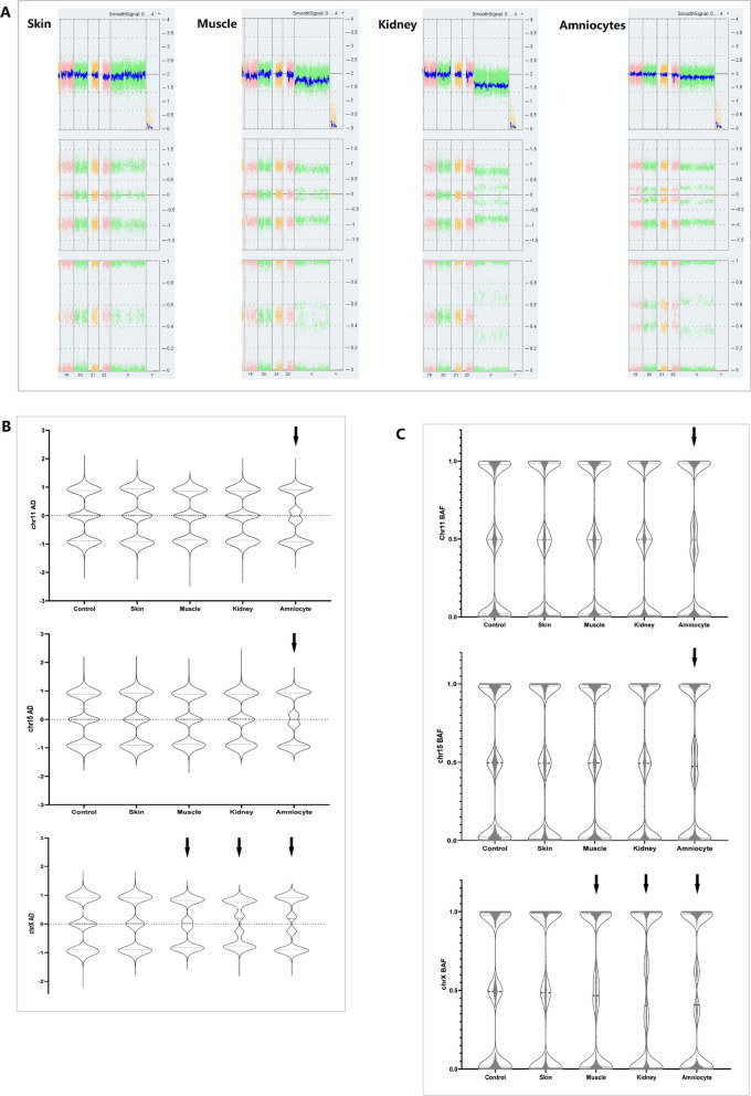 Prenatal diagnosis of mosaic chromosomal aneuploidy and uniparental disomy and clinical outcomes evaluation of four fetuses.