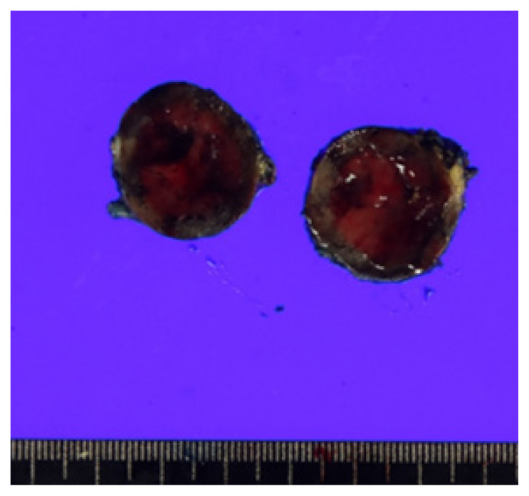 Unusual mesentery metastasis of differentiated thyroid cancer: a case report.