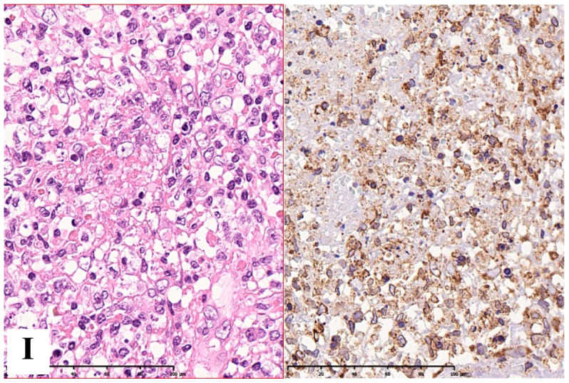 C/EBP homogenous protein-induced Apoptosis in Endoplasmic Reticulum stress has been implicated in Kikuchi-Fujimoto Disease.