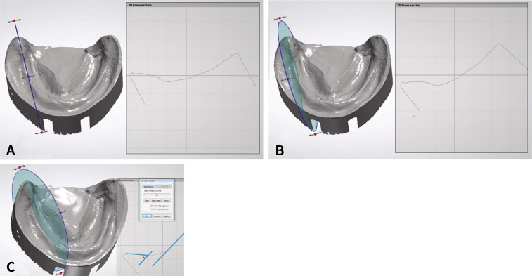 Three-dimensional morphometric study on the retromolar pad.