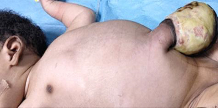 OBSTRUCTED CONGENITAL HERNIA OF UMBILICAL CORD IN A NIGERIAN NEWBORN AND ITS DIAGNOSTIC CONUNDRUM.