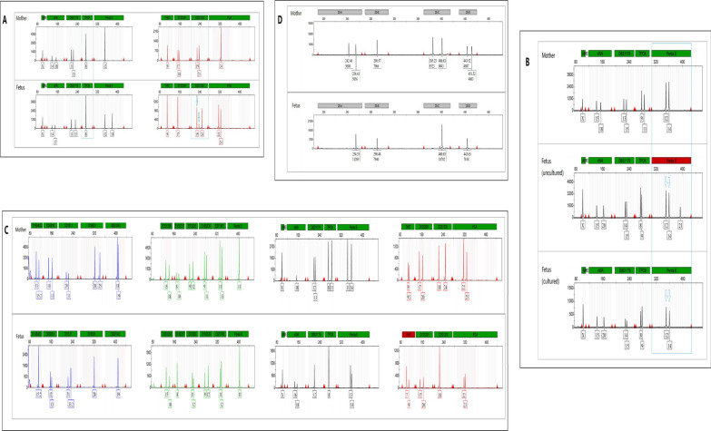 Prenatal diagnosis of mosaic chromosomal aneuploidy and uniparental disomy and clinical outcomes evaluation of four fetuses.