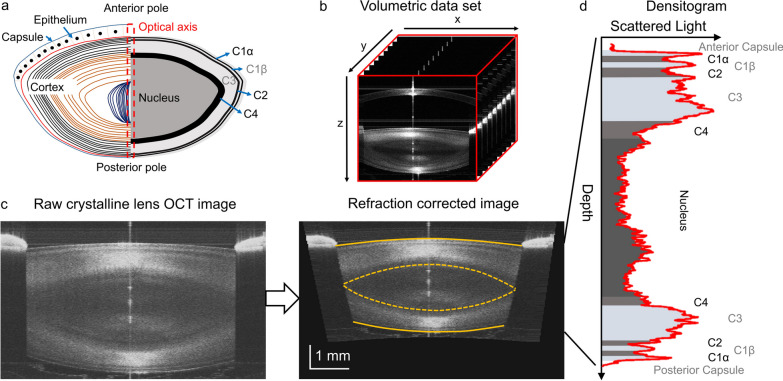 Age-related changes in geometry and transparency of human crystalline lens revealed by optical signal discontinuity zones in swept-source OCT images.