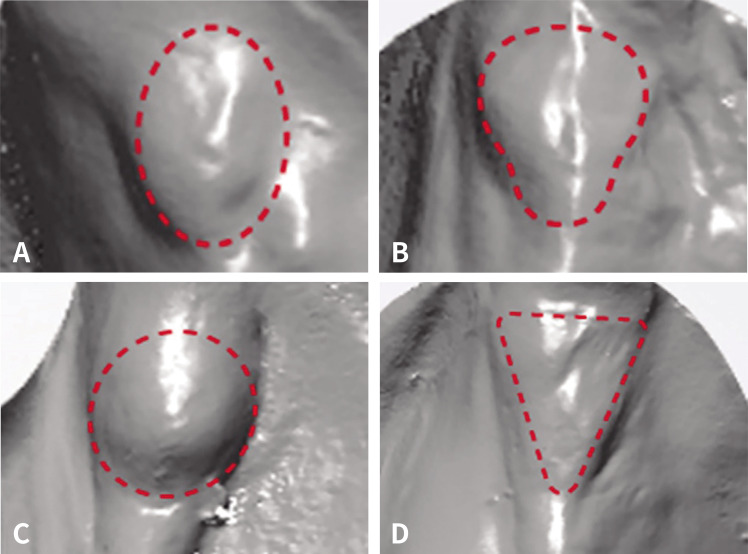 Three-dimensional morphometric study on the retromolar pad.