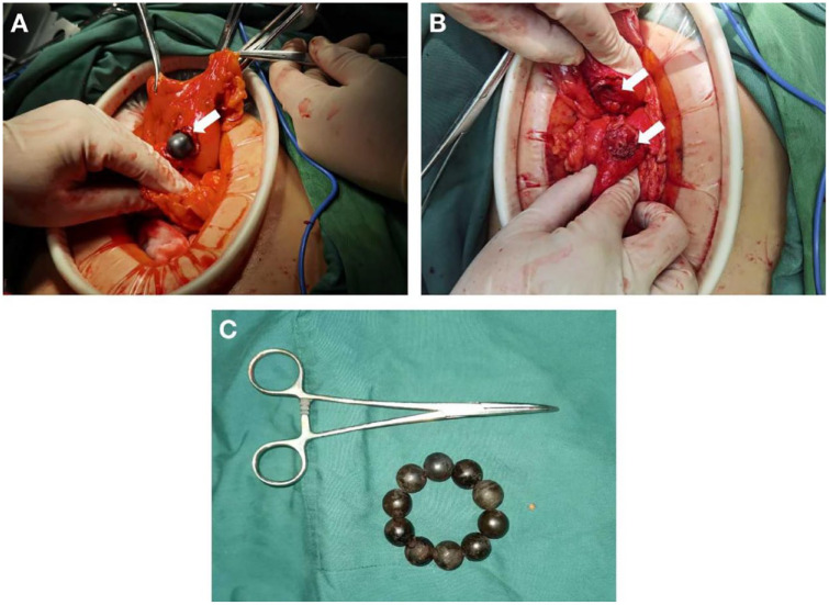 A 37-Year-Old Schizophrenic Woman With Abdominal Pain.