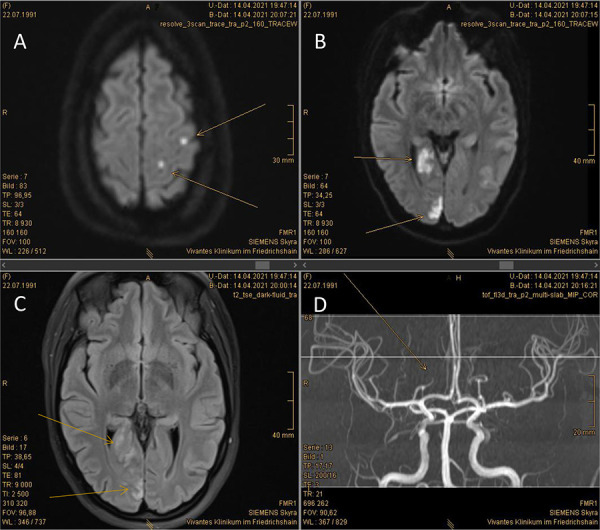 Concomitant presentation of thrombotic thrombocytopenic purpura, immune thrombocytopenia, and autoimmune hemolytic anemia in a patient with newly diagnosed systemic lupus erythematosus.