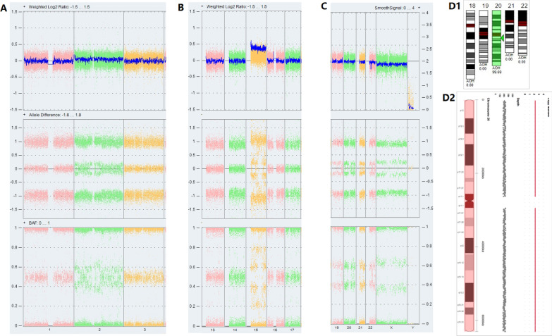 Prenatal diagnosis of mosaic chromosomal aneuploidy and uniparental disomy and clinical outcomes evaluation of four fetuses.
