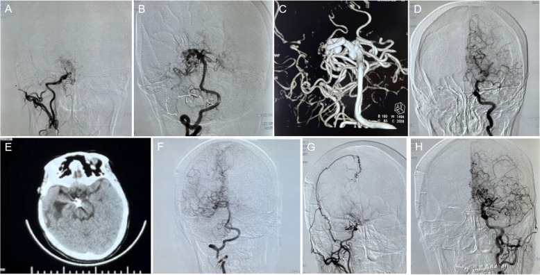 Classification and treatment strategy for Moyamoya disease-related aneurysms.