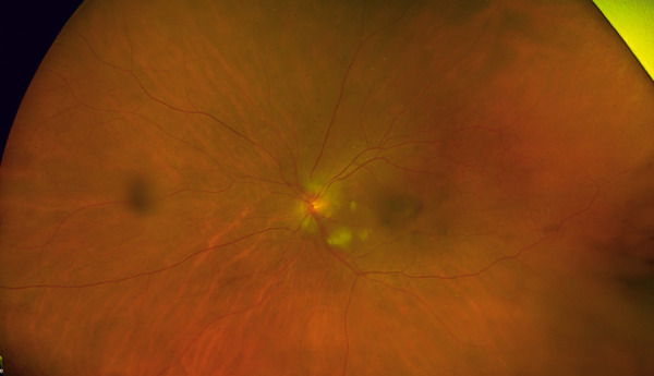 Calciphylaxis, beware the ophthalmic mimic: A case series.