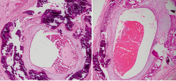 Calciphylaxis, beware the ophthalmic mimic: A case series.