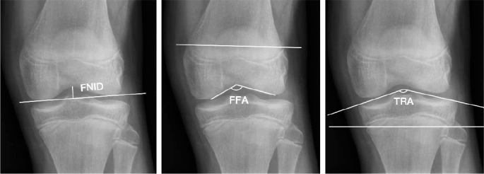 Morphology of the knee after guided growth using tension-band devices: a retrospective multicenter study of 222 limbs and 285 implants.