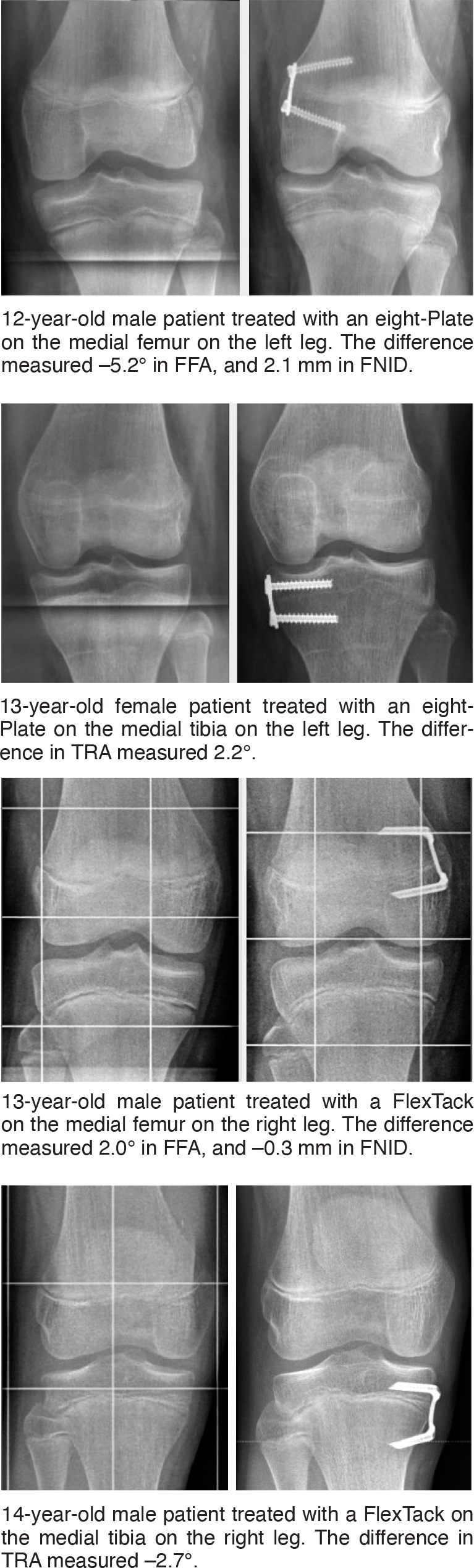 Morphology of the knee after guided growth using tension-band devices: a retrospective multicenter study of 222 limbs and 285 implants.